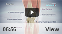ACL Reconstruction Hamstring Method