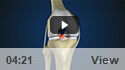 ACL Reconstruction Using Achilles Allograft