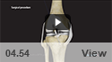 ACL Reconstruction with a Bone-Patellar Tendon-Bone (BPTB) Graft