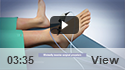 Ankle Arthroscopy