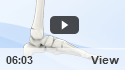 Ankle Fracture
