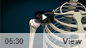 Arthroscopic Biologic Total Shoulder Resurfacing