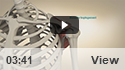 Arthroscopic Sub-acromial Decompression Surgery