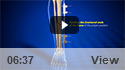 Bone Fracture Repair