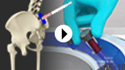 Spondyloarthritis