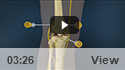 Coolief Procedure for Arthritis Pain