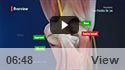 Cubital Tunnel Syndrome