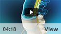 Degenerative Disc Disease
