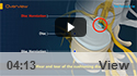 Disc Herniation