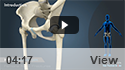 Femoral Neck Fracture