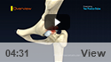 Femoroacetabular Impingement