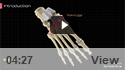 Foot Fracture