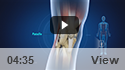Fractures of the Patella