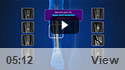 Fractures of the Tibia