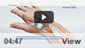 Ganglion Cyst Removal