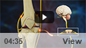 Genicular Nerve Block
