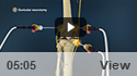 Genicular Neurotomy