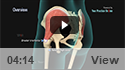 Gluteus Medius Tear