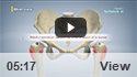 Hip Bursitis