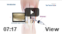 Knee Arthroscopy