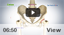 Labral Tears of the Hip