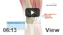 Medial Collateral Ligament Reconstruction