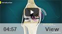 Microfracture