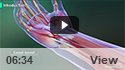 Mini-Open Carpal Tunnel Release Surgery