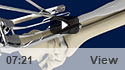 Minimally Invasive Achilles Repair