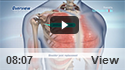 Minimally Invasive Shoulder Joint Replacement
