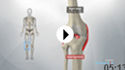 Spondyloarthritis