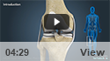 Multiligament Knee Reconstruction