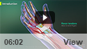 Open Carpal Tunnel Release Surgery