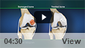 Osteochondral Allograft