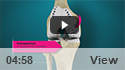 Osteochondral Autograft