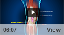 Patellar Tendon Rupture and Repair