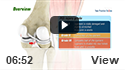 Posterior Cruciate Ligament Reconstruction