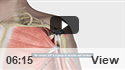 Rotator Cuff Bursitis