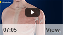 Rotator Cuff Tear