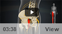 Sciatica