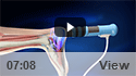 Shockwave Therapy