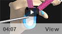 SLAP Repair