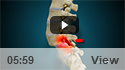Spondylolisthesis