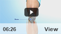 Subchondroplasty