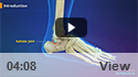 Subtalar Arthroscopy