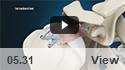 Superior Capsule Reconstruction
