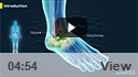 Syndesmosis Surgery Without The Tightrope