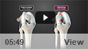 Tibial Tubercle Osteotomy