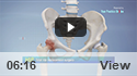 Total Hip Replacement