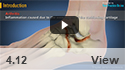 Triple Arthrodesis